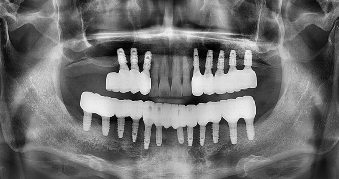 상악동거상술 증례2 After